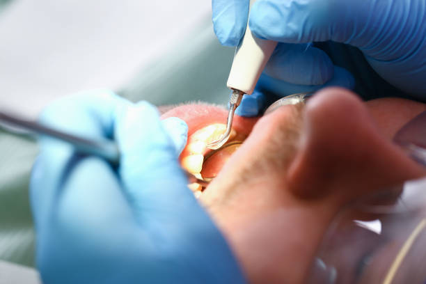 Best Emergency Dentist for Lost Fillings or Crowns in Brooklyn, NY